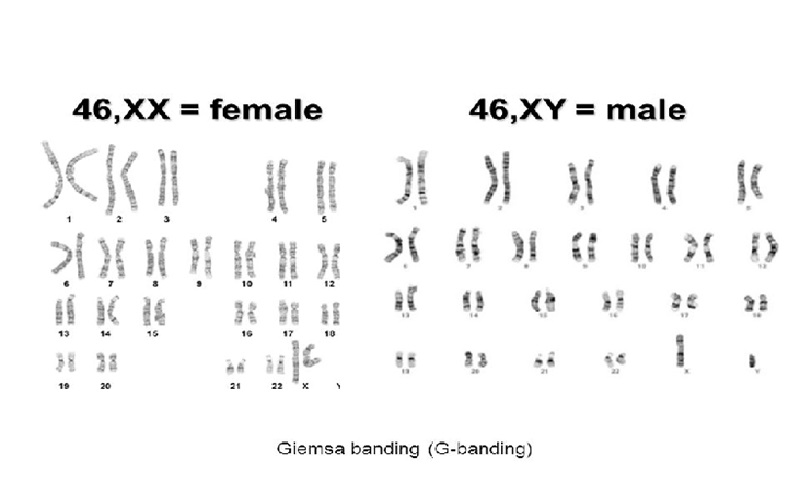 Hình ảnh 1: Bộ nhiễm sắc thể bình thường ở nữ ( 46,XX) và ở nam ( 46,XY).