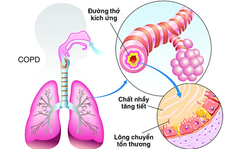 Hình 2: Bệnh COPD