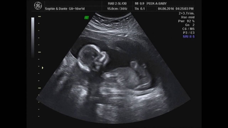 Hình ảnh thai nhi 4 tháng tuổi qua siêu âm