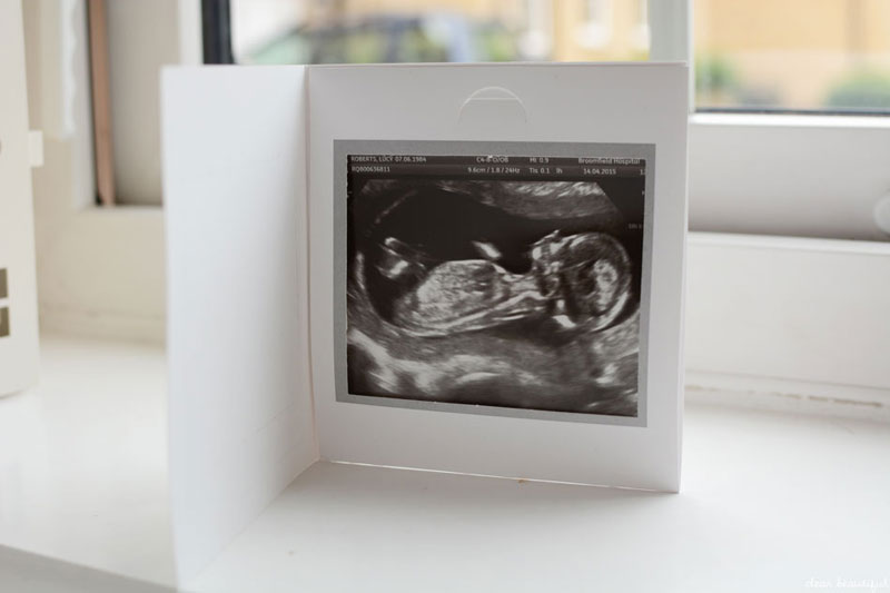 Siêu âm thai giúp mẹ bầu theo dõi được tiến trình phát triển của thai nhi