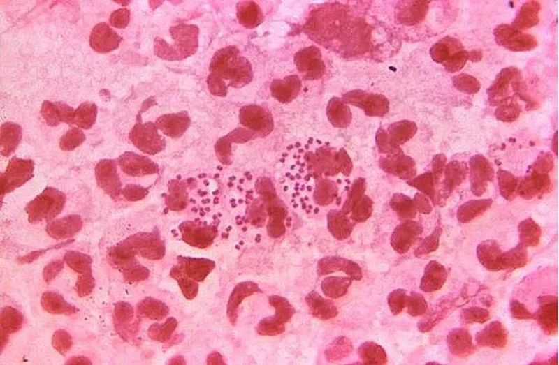 Hình ảnh vi khuẩn Lậu khi nhuộm soi dịch sinh dục