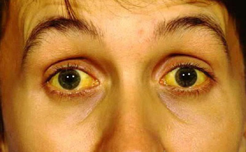 Hình ảnh vàng da vàng mắt do Leptospira