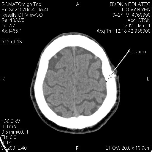 Hình ảnh chụp CT sọ não rõ nét