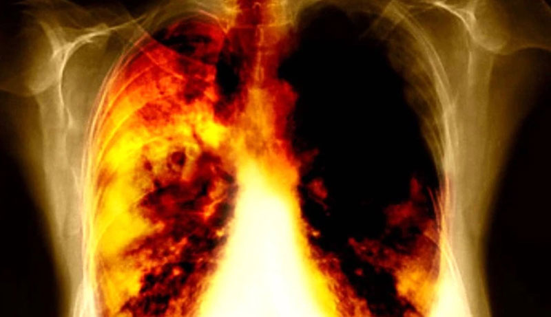 Ung thư phổi giai đoạn cuối là một căn bệnh đáng sợ với tỷ lệ tử vong cao