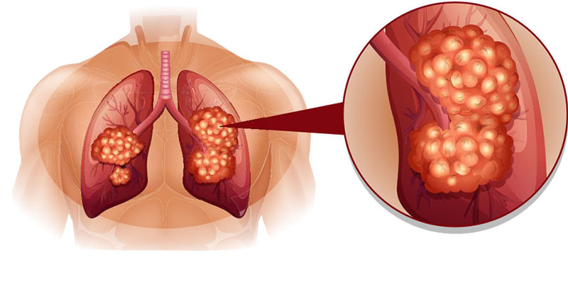 Ung thư phổi là tình trạng xuất hiện các tế bào bất thường phát triển trong phổi