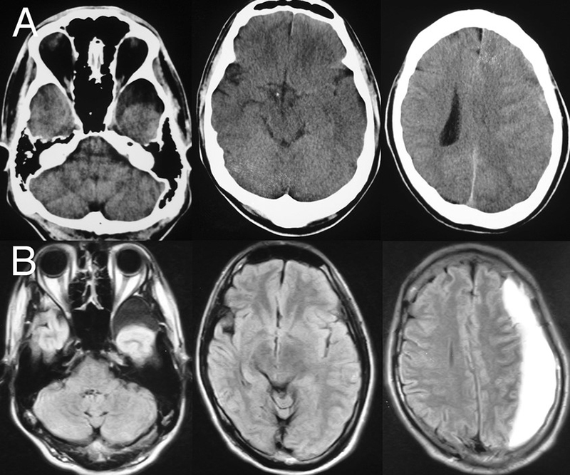 CT và MRI là hai phương pháp thường dùng để thăm khám tổn thương tại nhu mô não