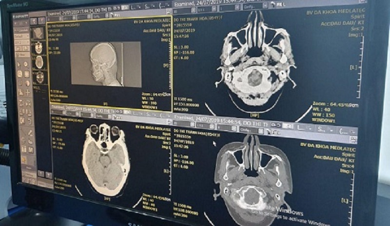 Hình ảnh chụp CT cắt lớp não có độ phân giải cao, giúp đánh giá chính xác tổn thương vùng đầu - mặt