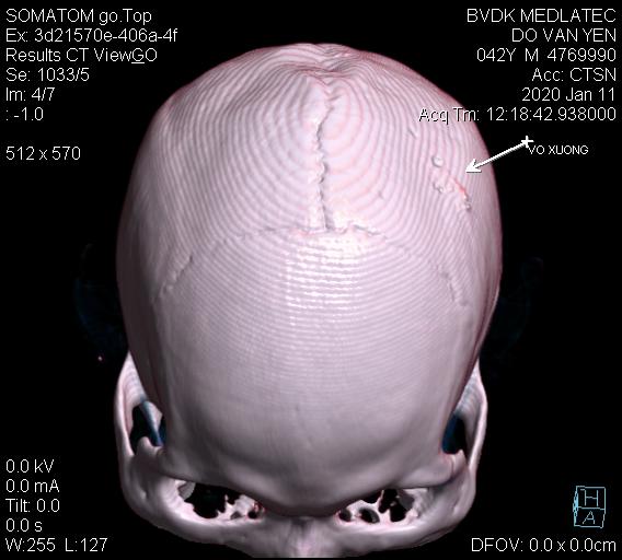 Hình ảnh thu được từ chụp CT cắt lớp não tương đối rõ nét
