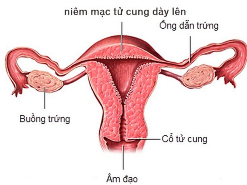 Niêm mạc tử cung ảnh hưởng đến khả năng thụ thai ở phụ nữ
