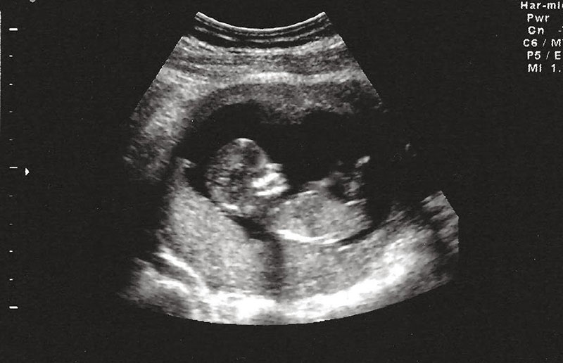 Đến nay, khoa học vẫn chưa có bằng chứng siêu âm gây hại cho mẹ bầu và thai nhi trong bụng