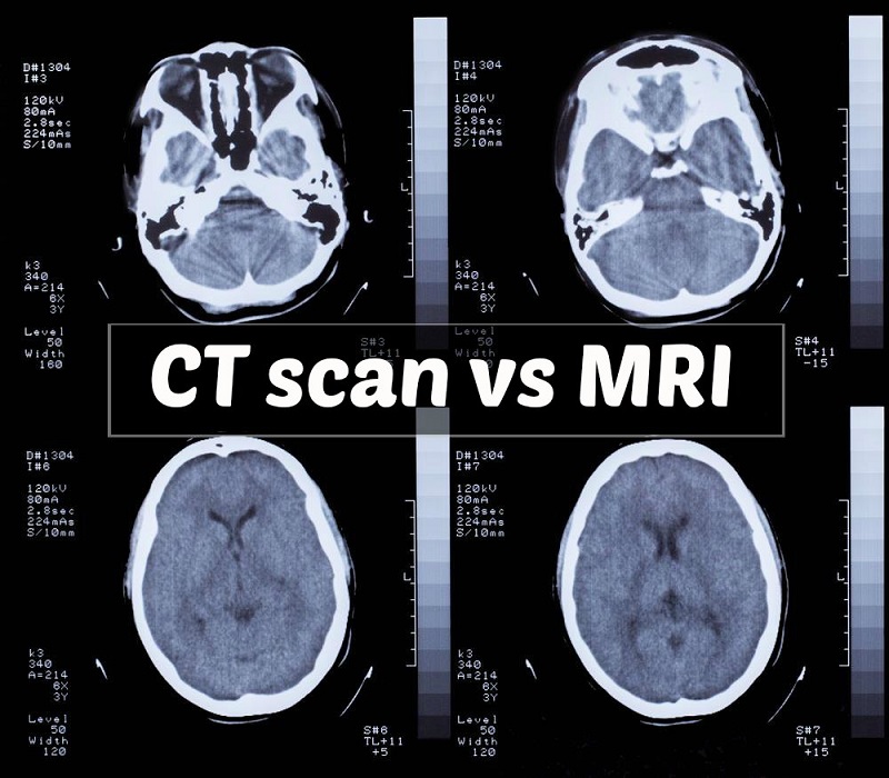 Do sử dụng kỹ thuật không giống nhau nên hình ảnh thu được sau khi chụp CT và MRI cũng có sự khác nhau