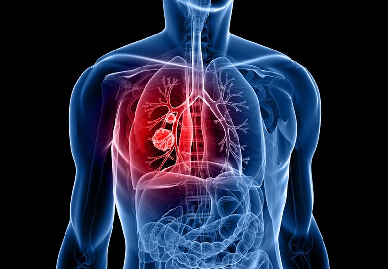 Các tế bào biểu mô trong phổi phát triển một cách bất thường dẫn đến khối u ác tính