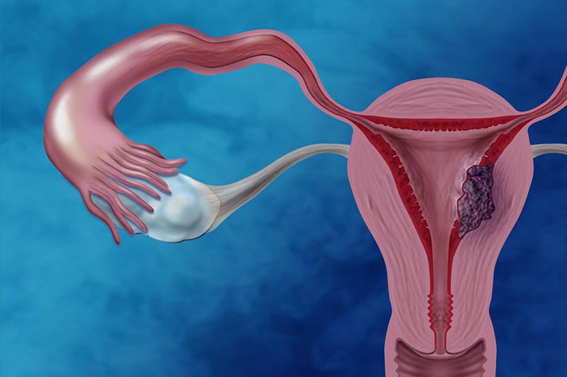U nang buồng trứng về lâu dài không điều trị có thể dẫn tới ung thư