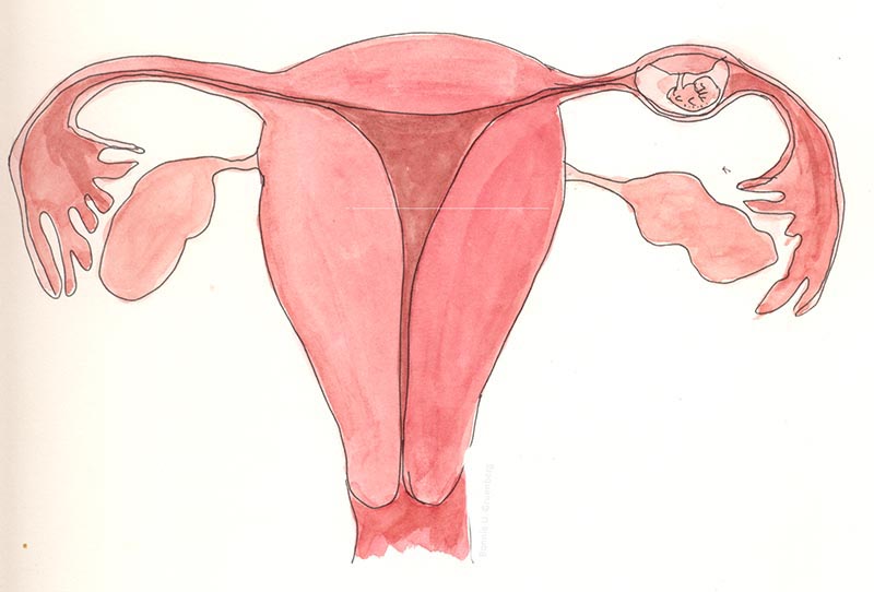 Mang thai ngoài tử cung do dính buồng tử cung