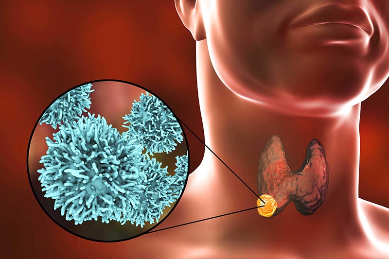 Các tế bào tuyến giáp phát triển một cách bất thường dẫn đến hình thành nhân khối u