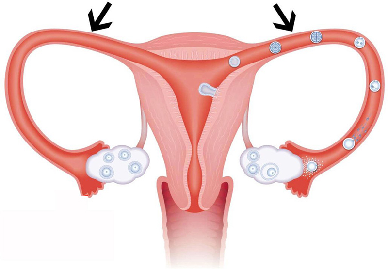 Vòi trứng hay còn gọi là ống dẫn trứng là bộ phận quan trọng trong cơ quan sinh sản phụ nữ.