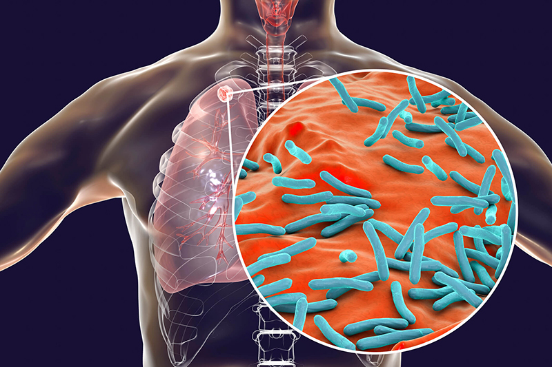 Mycobacterium Tuberculosis là tác nhân chính gây nên bệnh lao màng phổi
