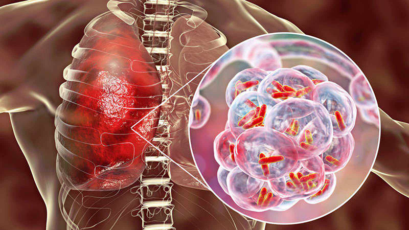 Bệnh lao màng phổi là một dạng phổ biến của thể lao ngoài phổi do vi khuẩn Mycobacterium Tuberculosis gây ra