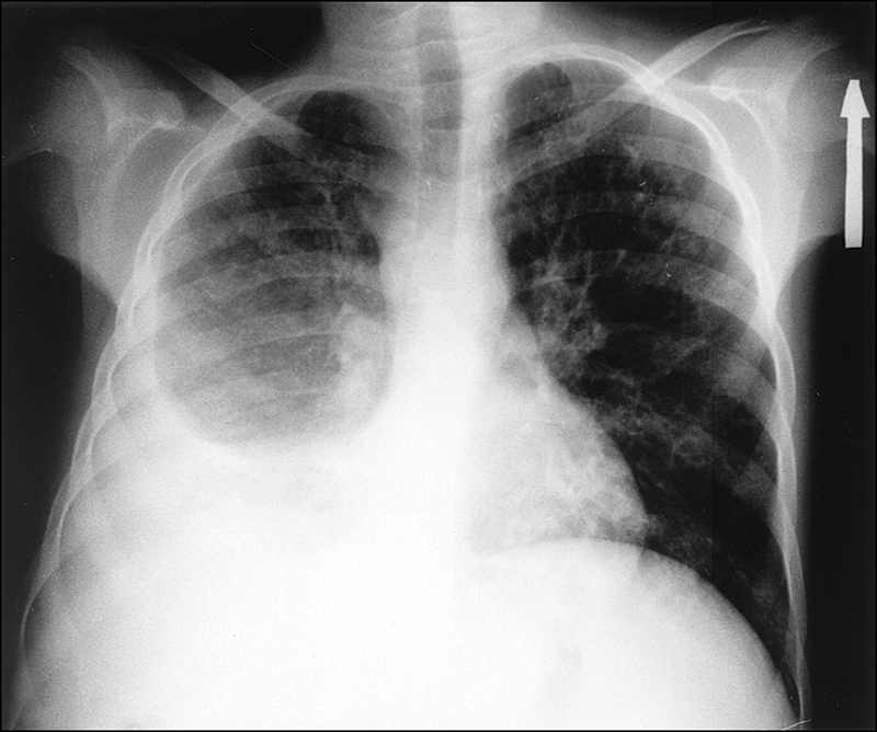 Kết quả chẩn đoán tràn dịch màng phổi bằng hình ảnh