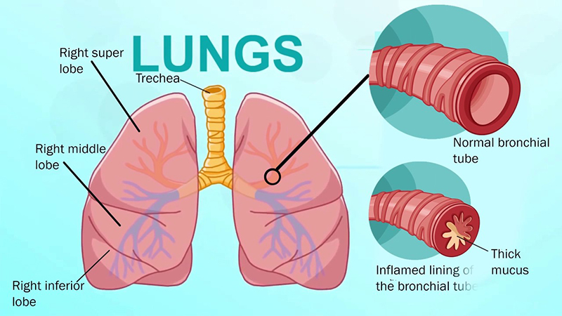 Viêm phế quản là chứng bệnh về đường hô hấp dễ gặp phải