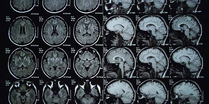 Chụp cộng hưởng từ não giúp xác định chính xác các bệnh lý nguy hiểm về não 