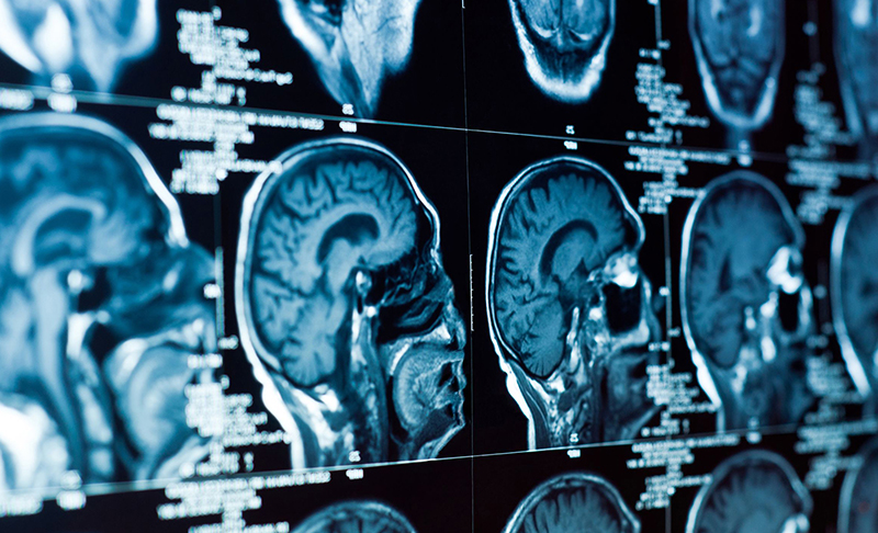 Chụp cộng hưởng từ giúp xác định bệnh lý liên quan đến não bộ