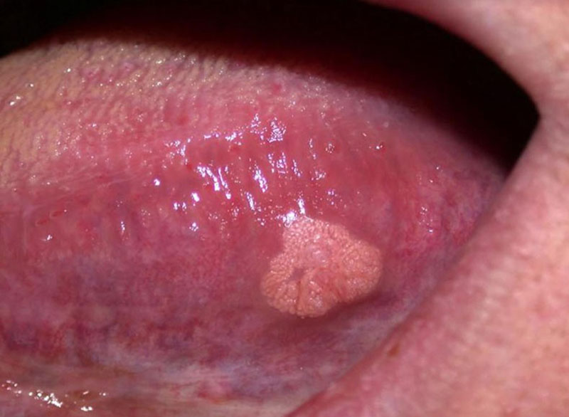 Thói quen quan hệ tình dục bằng miệng sẽ làm tăng nguy cơ lây nhiễm virus HPV