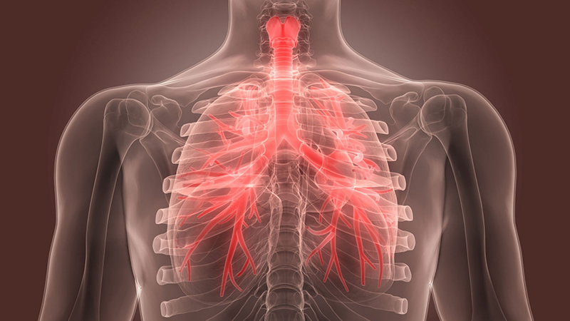 Viêm phế quản là bệnh lý về hô hấp, gây ảnh hưởng trực tiếp tới sức khỏe người bệnh