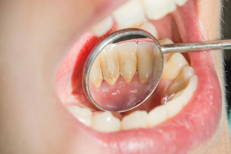 cao vôi răng có thể do bệnh lý