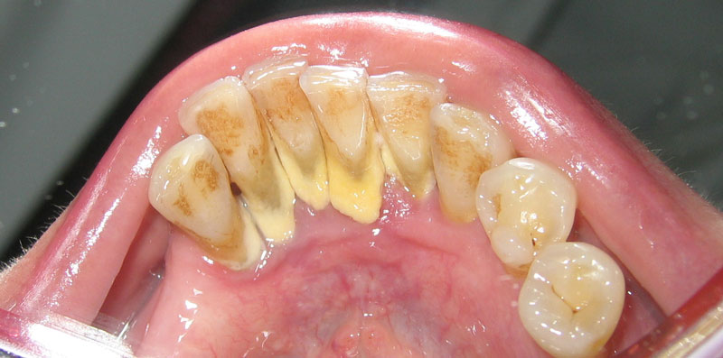 cao vôi răng cần được thực hiện lấy định kỳ