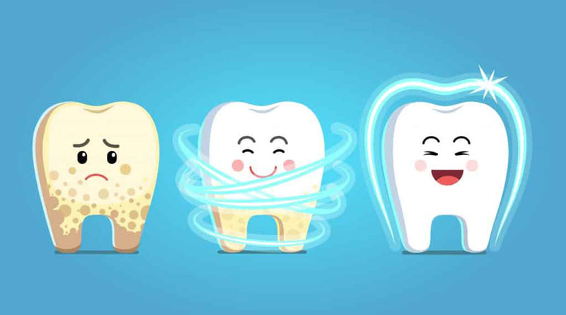 cao vôi răng cần được chăm sóc thường xuyên