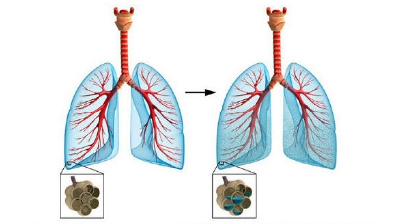 khó thở khi nằm ngửa có thể do mắc bệnh viêm phổi