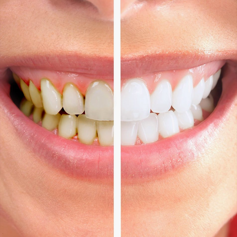 Cao răng là các mảng bám hay mảng vi khuẩn bị vôi hóa và cứng lại