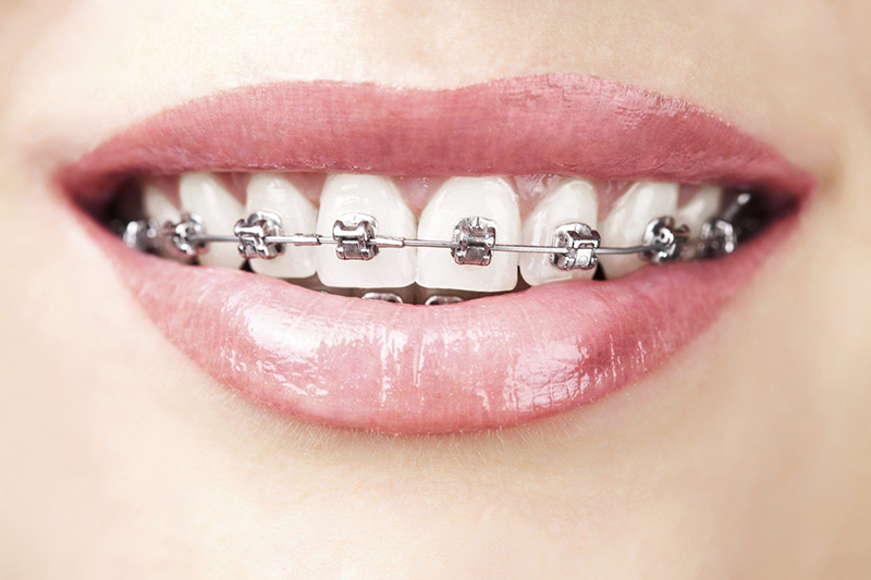 Niềng răng cũng là nguyên nhân gây lở miệng mà ít người để ý
