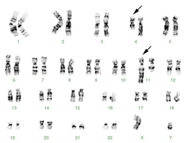Karyotype người nam mang NST chuyển đoạn giữa NST số 4 và 11