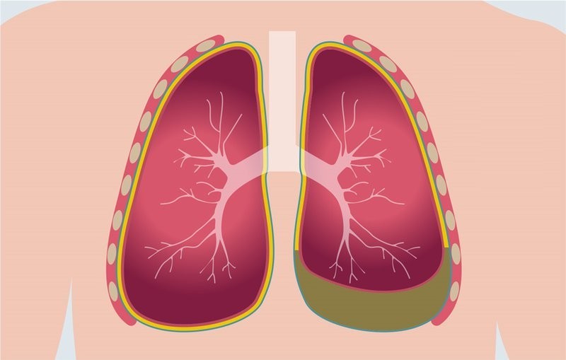 Phần màu xanh chính là lượng dịch trong màng phổi tăng lên gây ra tràn dịch màng phổi