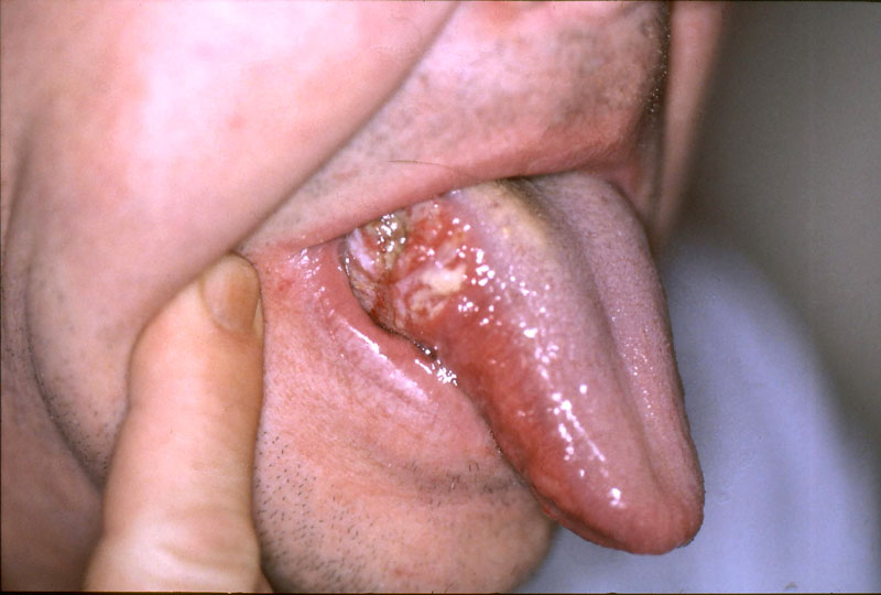 Đến giai đoạn cuối lưỡi của bệnh nhân đã bị tổn thương cực kỳ nghiêm trọng