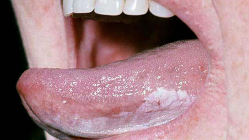 Trong giai đoạn khởi phát trên lưỡi bệnh nhân xuất hiện nhiều mảng trắng bám chặt