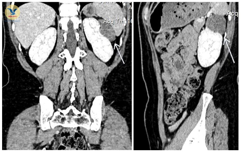 Hình ảnh chụp CT 128 dãy chẩn đoán tổn thương phổi