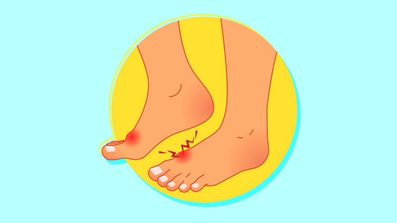 Ở bệnh nhân gout có biểu hiện sưng đỏ, viêm và nóng ra xung quanh các khớp
