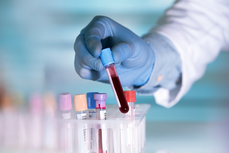 Xét nghiệm máu là phương pháp thường dùng để chẩn đoán thiếu máu
