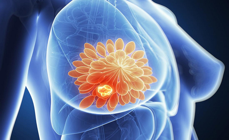 Ung thư vú là bệnh thường gặp ở phụ nữ trên 35 tuổi