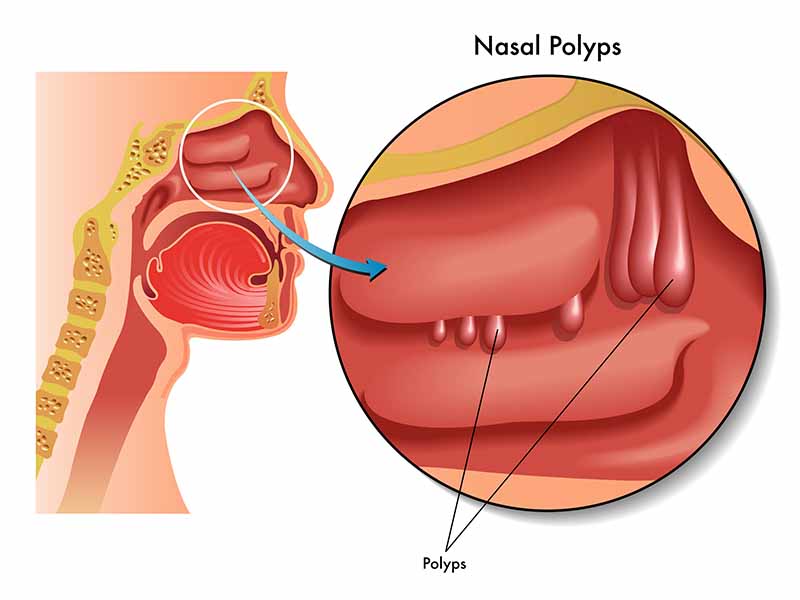 Polyp xoang hàm là sự xuất hiện các khối u lành tính trên niêm mạc vùng mũi