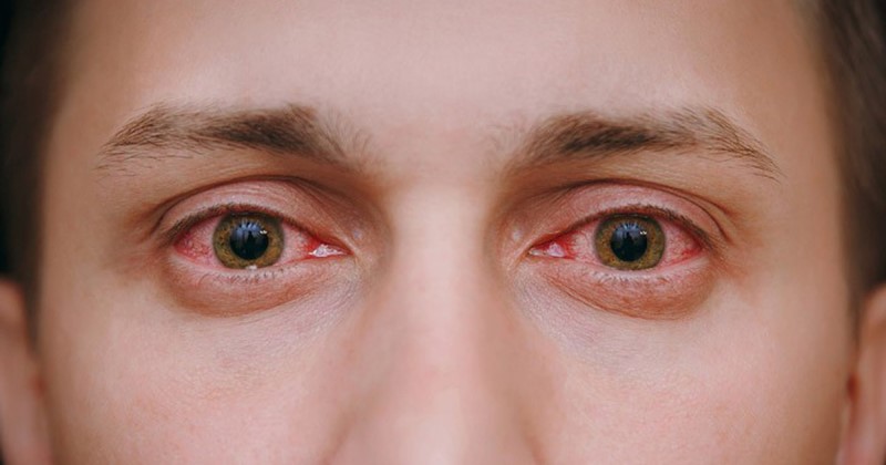 Người bị đau mắt đỏ hay gặp các vấn đề về bề mặt mắt thường được sử dụng các loại dung dịch nhỏ mắt tại chỗ
