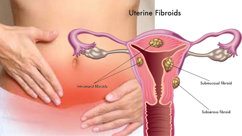 Bệnh nhân u xơ tử cung đa phần là nữ giới trong độ tuổi sinh sản hoặc thời kỳ mãn kinh