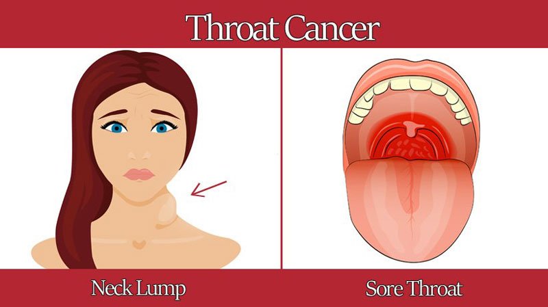 dấu hiệu ung thư vòm họng với các biểu hiện đau tức ở vùng cổ họng