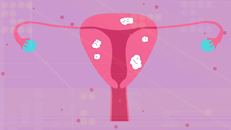 U xơ tử cung có thể gây ra triệu chứng rong kinh