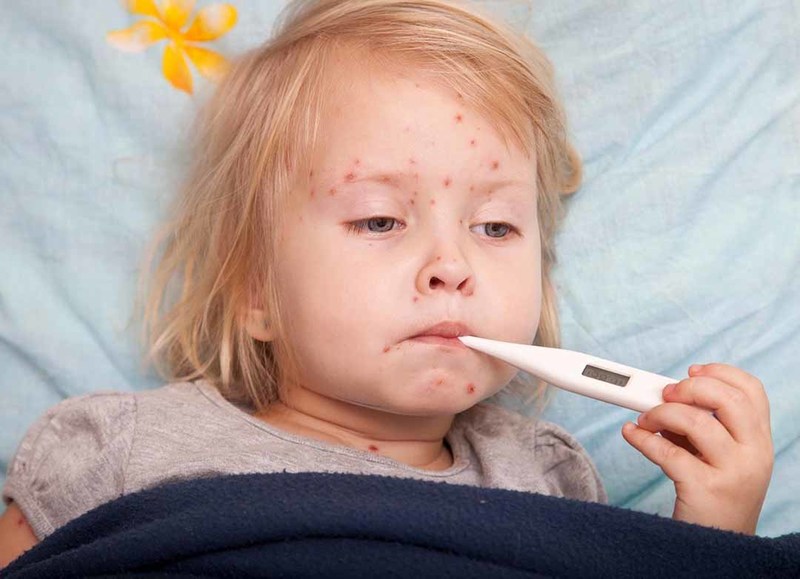  Cần đặc biệt lưu ý đến các biểu hiện của trẻ bị sốt xuất huyết