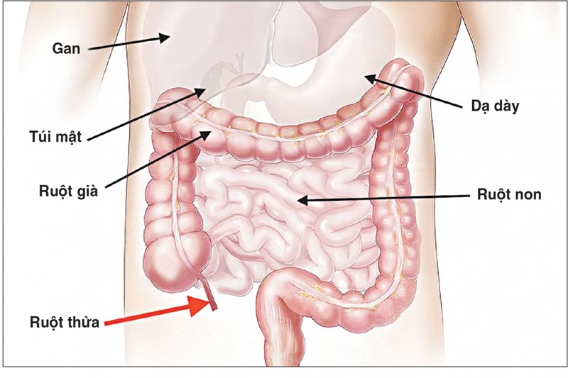 Viêm ruột thừa có thể dẫn tới tình trạng đau bụng bên phải