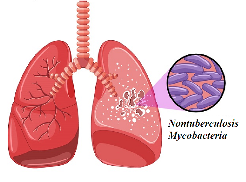 Nontuberculous Mycobacteria gây tổn thương phổi